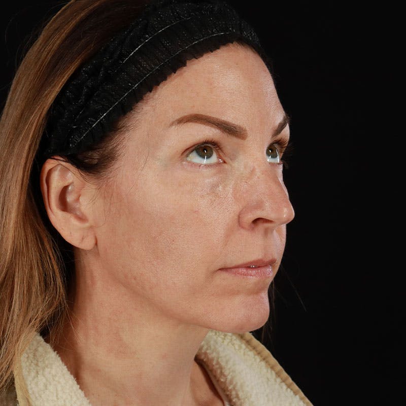 PRP/PRF Therapy Before & After Gallery - Patient 355401 - Image 5