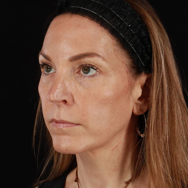PRP/PRF Therapy Before & After Gallery - Patient 355401 - Image 8