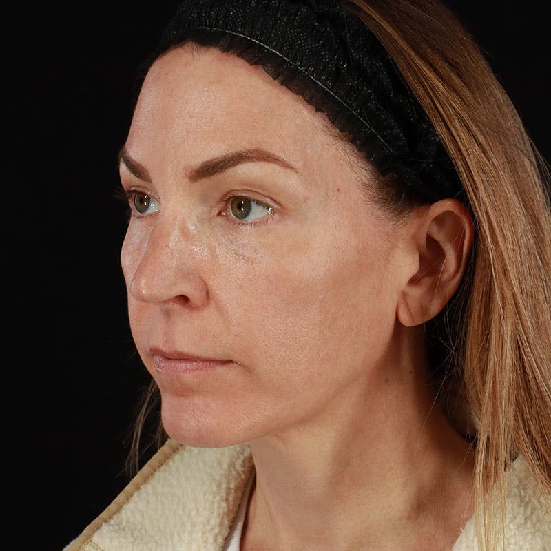 PRP/PRF Therapy Before & After Gallery - Patient 355401 - Image 7