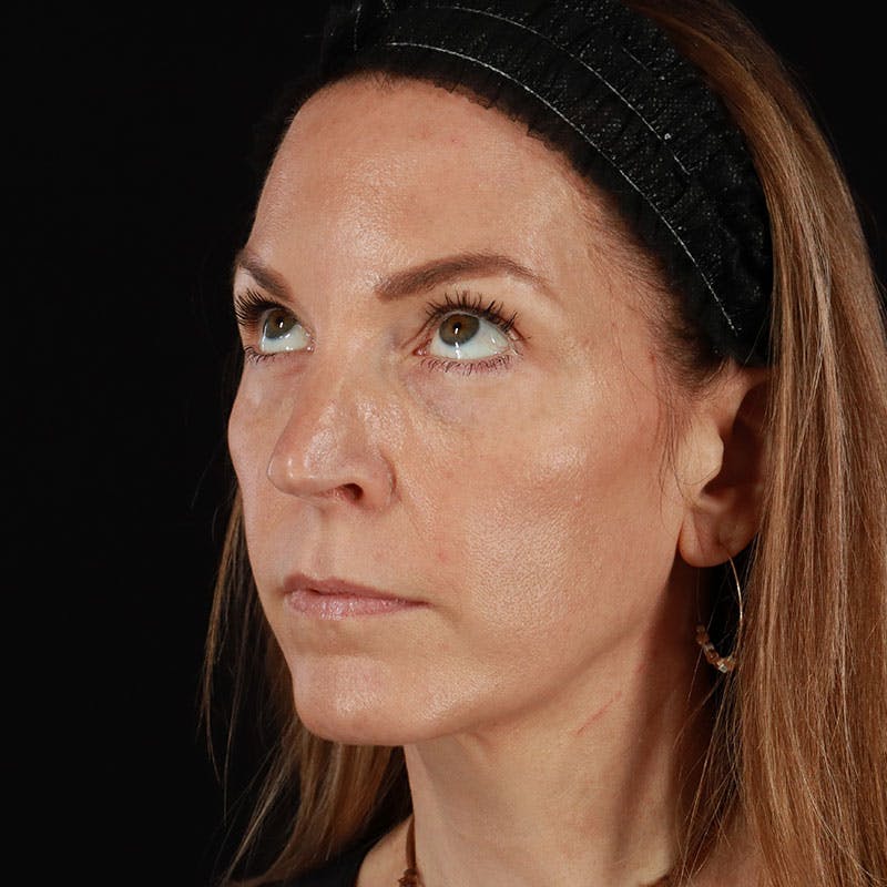 PRP/PRF Therapy Before & After Gallery - Patient 355401 - Image 10