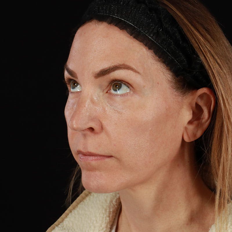 PRP/PRF Therapy Before & After Gallery - Patient 355401 - Image 9