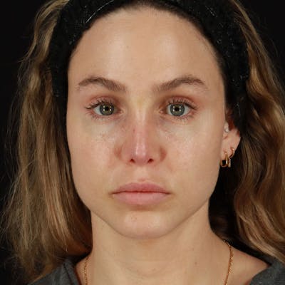 PRP/PRF Therapy Before & After Gallery - Patient 562242 - Image 1