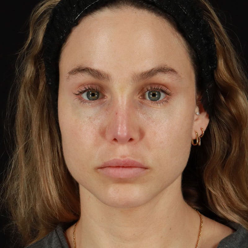 PRP/PRF Therapy Before & After Gallery - Patient 562242 - Image 1