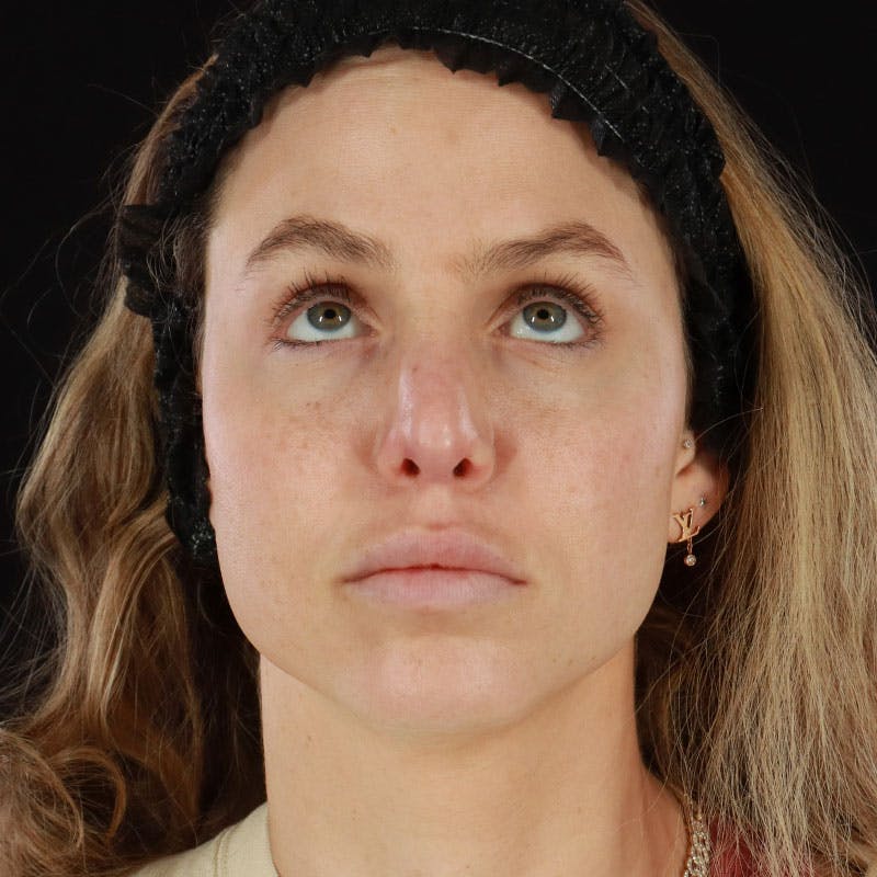 PRP/PRF Therapy Before & After Gallery - Patient 562242 - Image 4