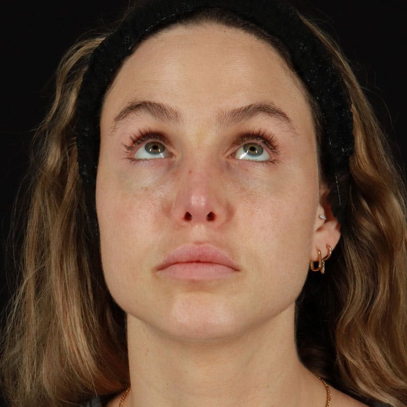 PRP/PRF Therapy Before & After Gallery - Patient 562242 - Image 3