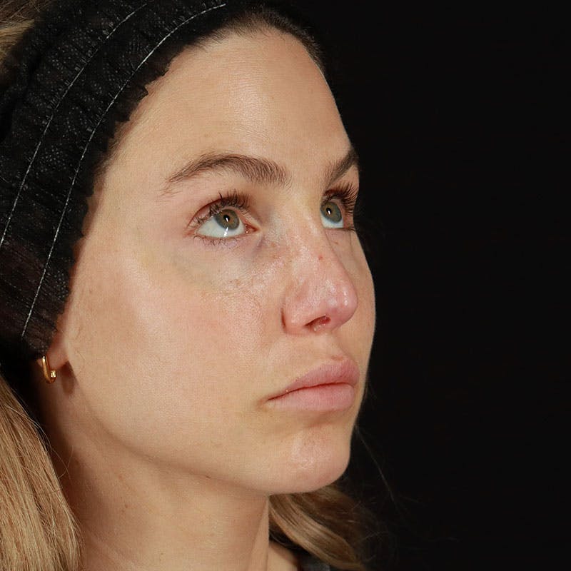 PRP/PRF Therapy Before & After Gallery - Patient 562242 - Image 7