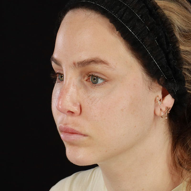 PRP/PRF Therapy Before & After Gallery - Patient 562242 - Image 6