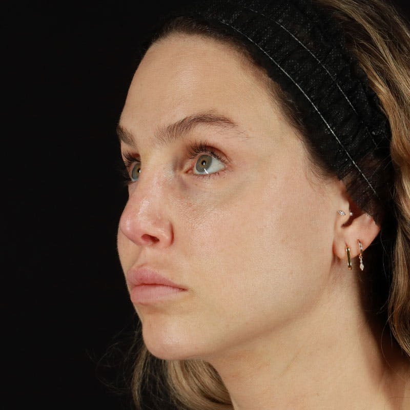 PRP/PRF Therapy Before & After Gallery - Patient 562242 - Image 5