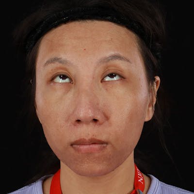PRP/PRF Therapy Before & After Gallery - Patient 185774 - Image 1