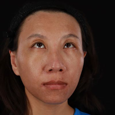 PRP/PRF Therapy Before & After Gallery - Patient 185774 - Image 2