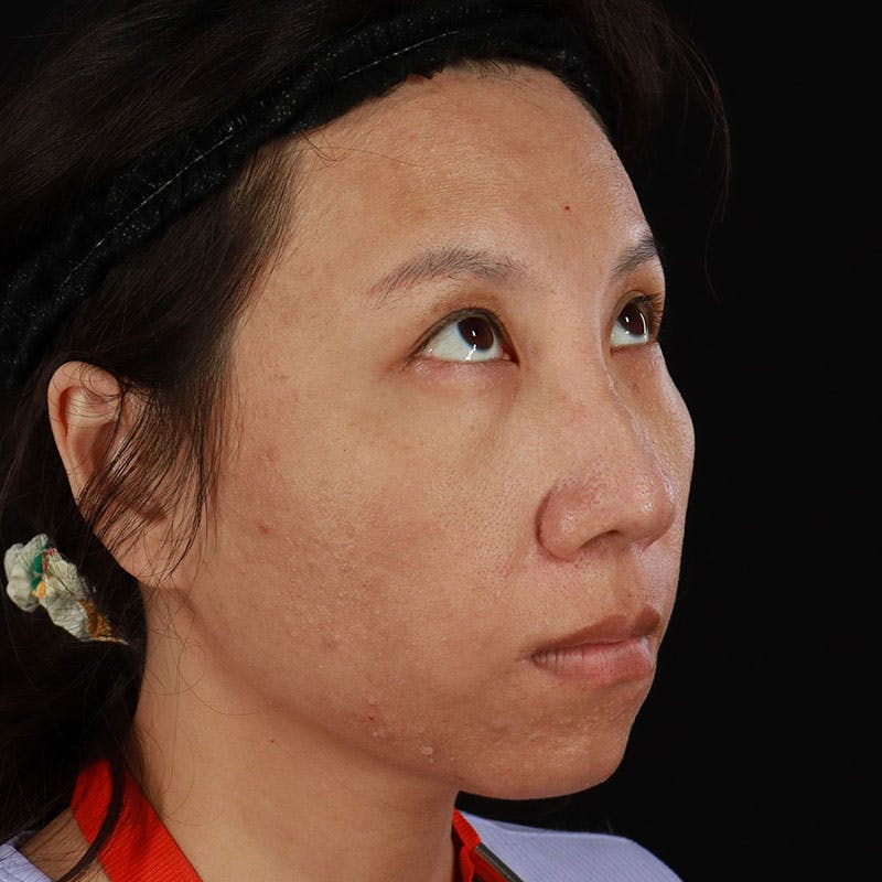PRP/PRF Therapy Before & After Gallery - Patient 185774 - Image 3