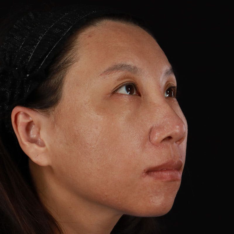 PRP/PRF Therapy Before & After Gallery - Patient 185774 - Image 4