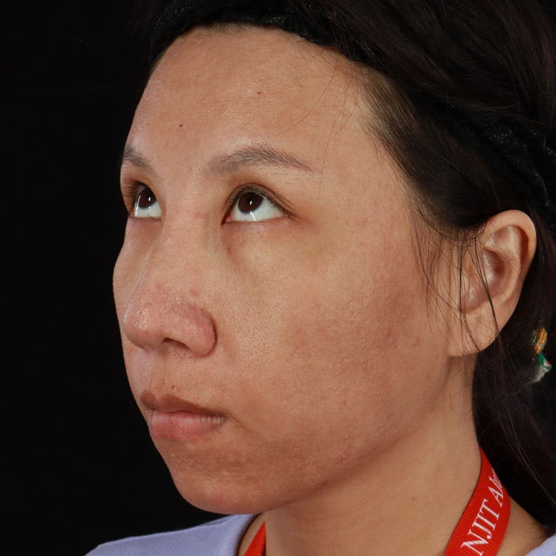 PRP/PRF Therapy Before & After Gallery - Patient 185774 - Image 5