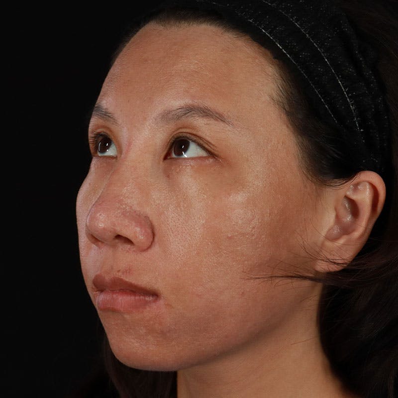 PRP/PRF Therapy Before & After Gallery - Patient 185774 - Image 6