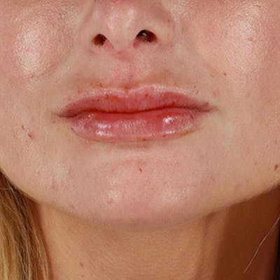 Dermal Fillers Before & After Gallery - Patient 210694 - Image 2