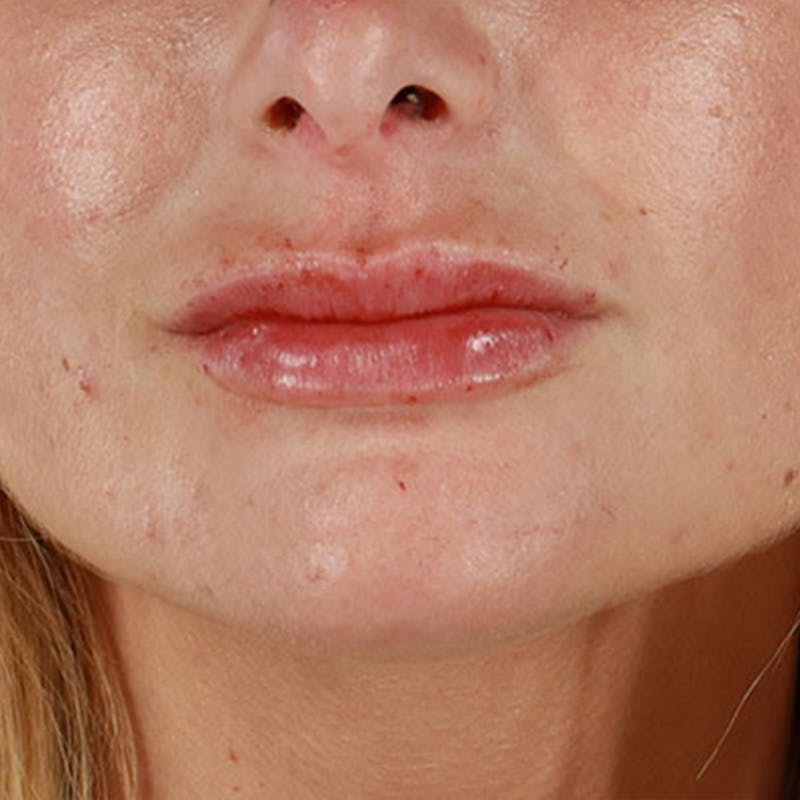 Dermal Fillers Before & After Gallery - Patient 210694 - Image 2