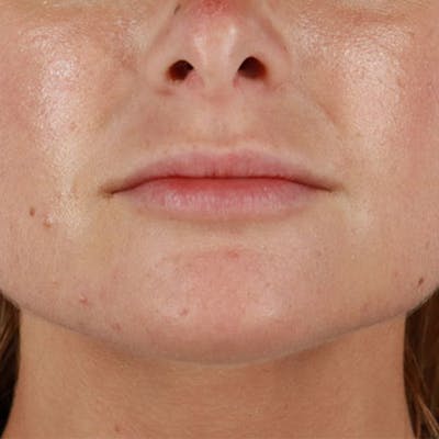 Dermal Fillers Before & After Gallery - Patient 210694 - Image 1