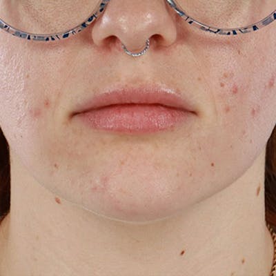 Dermal Fillers Before & After Gallery - Patient 261372 - Image 1