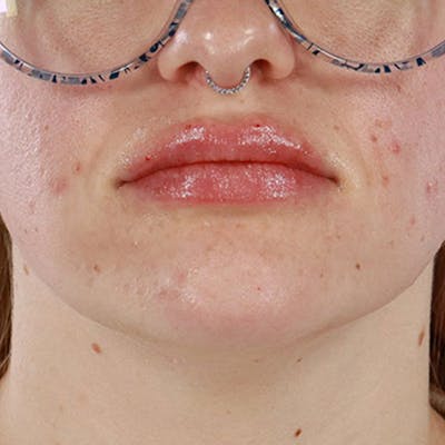 Dermal Fillers Before & After Gallery - Patient 261372 - Image 2
