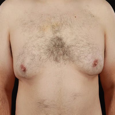 Gynecomastia Before & After Gallery - Patient 275896 - Image 1