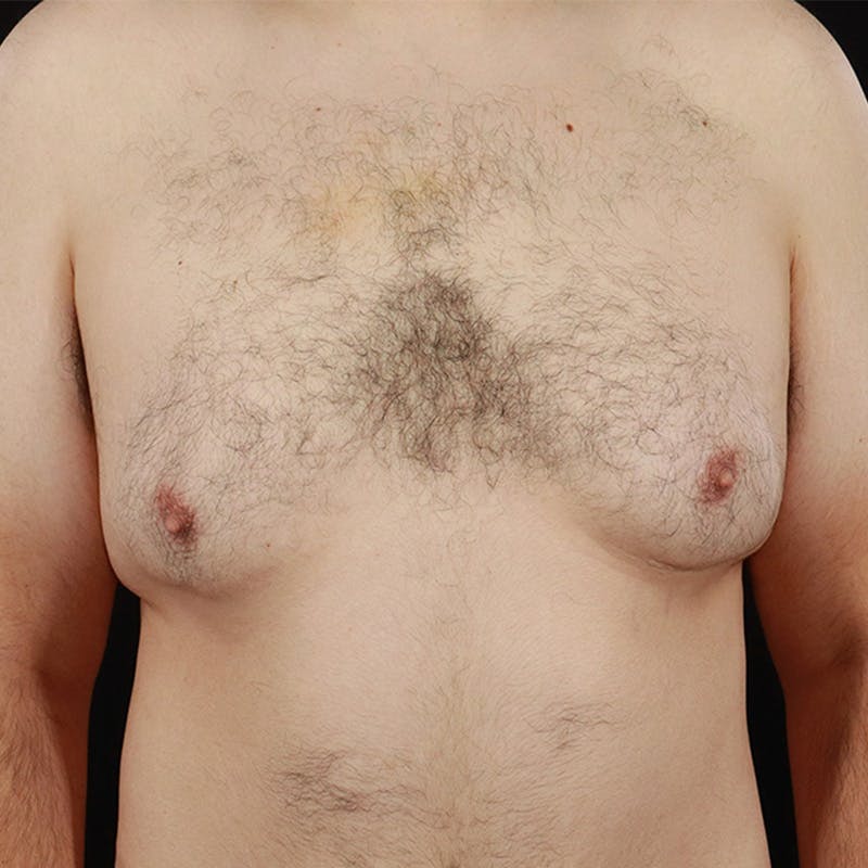 Gynecomastia Before & After Gallery - Patient 275896 - Image 1