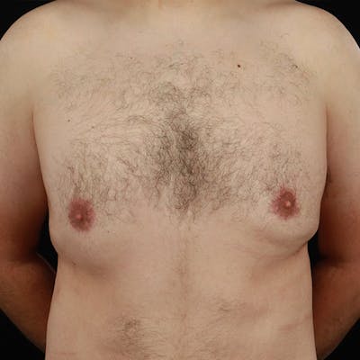 Gynecomastia Before & After Gallery - Patient 275896 - Image 2