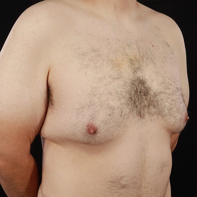 Gynecomastia Before & After Gallery - Patient 275896 - Image 3