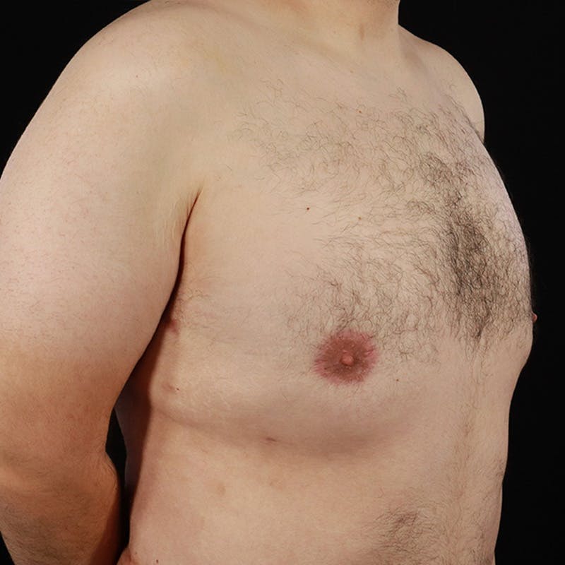 Gynecomastia Before & After Gallery - Patient 275896 - Image 4