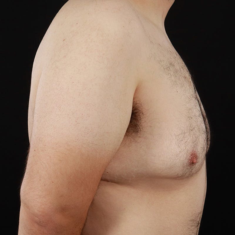 Gynecomastia Before & After Gallery - Patient 275896 - Image 5