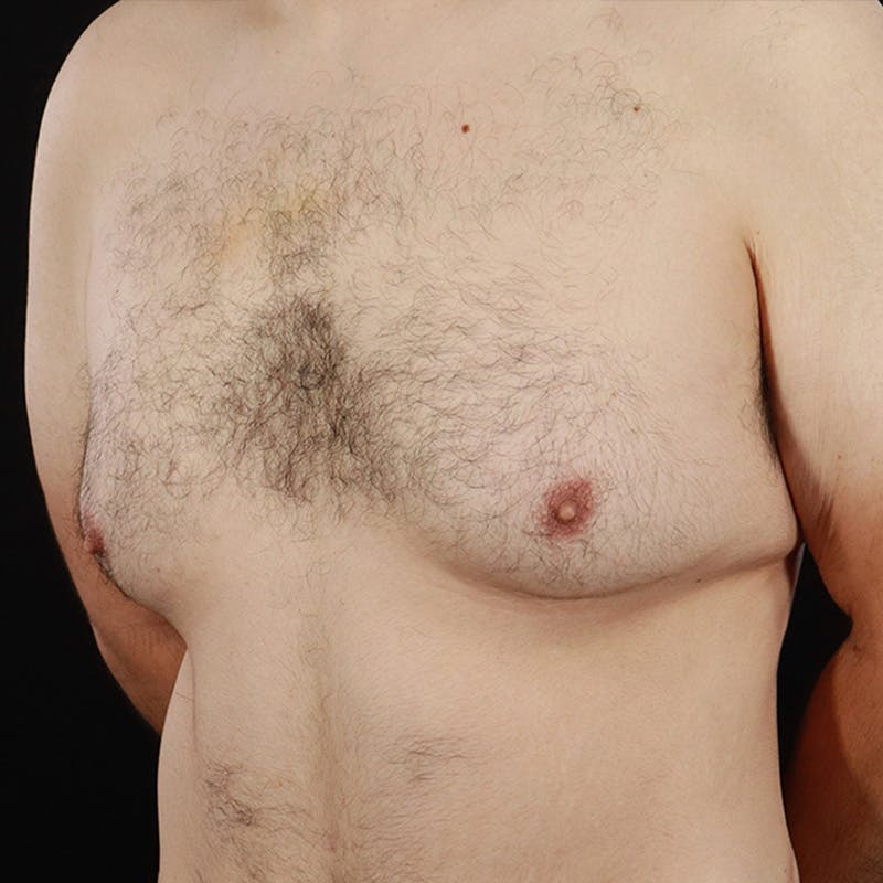 Gynecomastia Before & After Gallery - Patient 275896 - Image 7