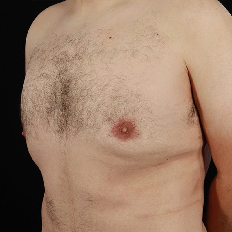 Gynecomastia Before & After Gallery - Patient 275896 - Image 8