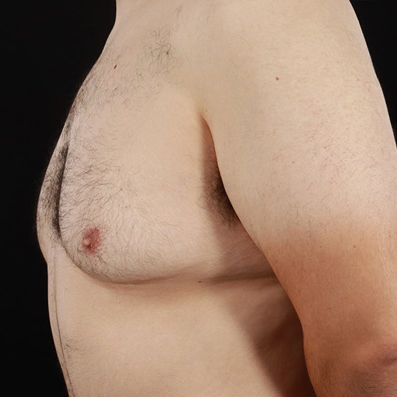 Gynecomastia Before & After Gallery - Patient 275896 - Image 9