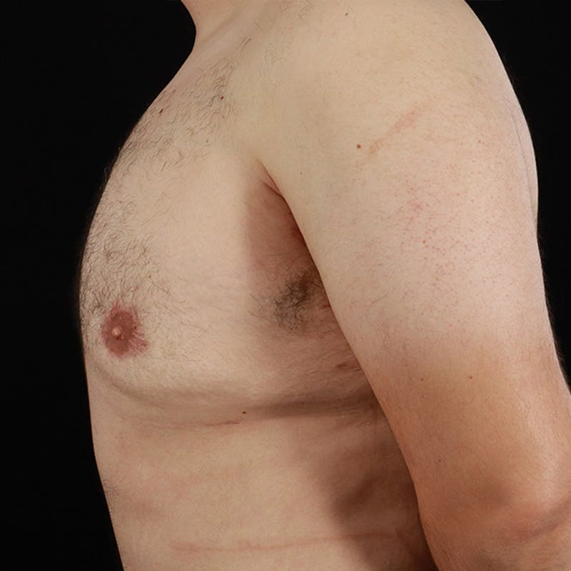 Gynecomastia Before & After Gallery - Patient 275896 - Image 10