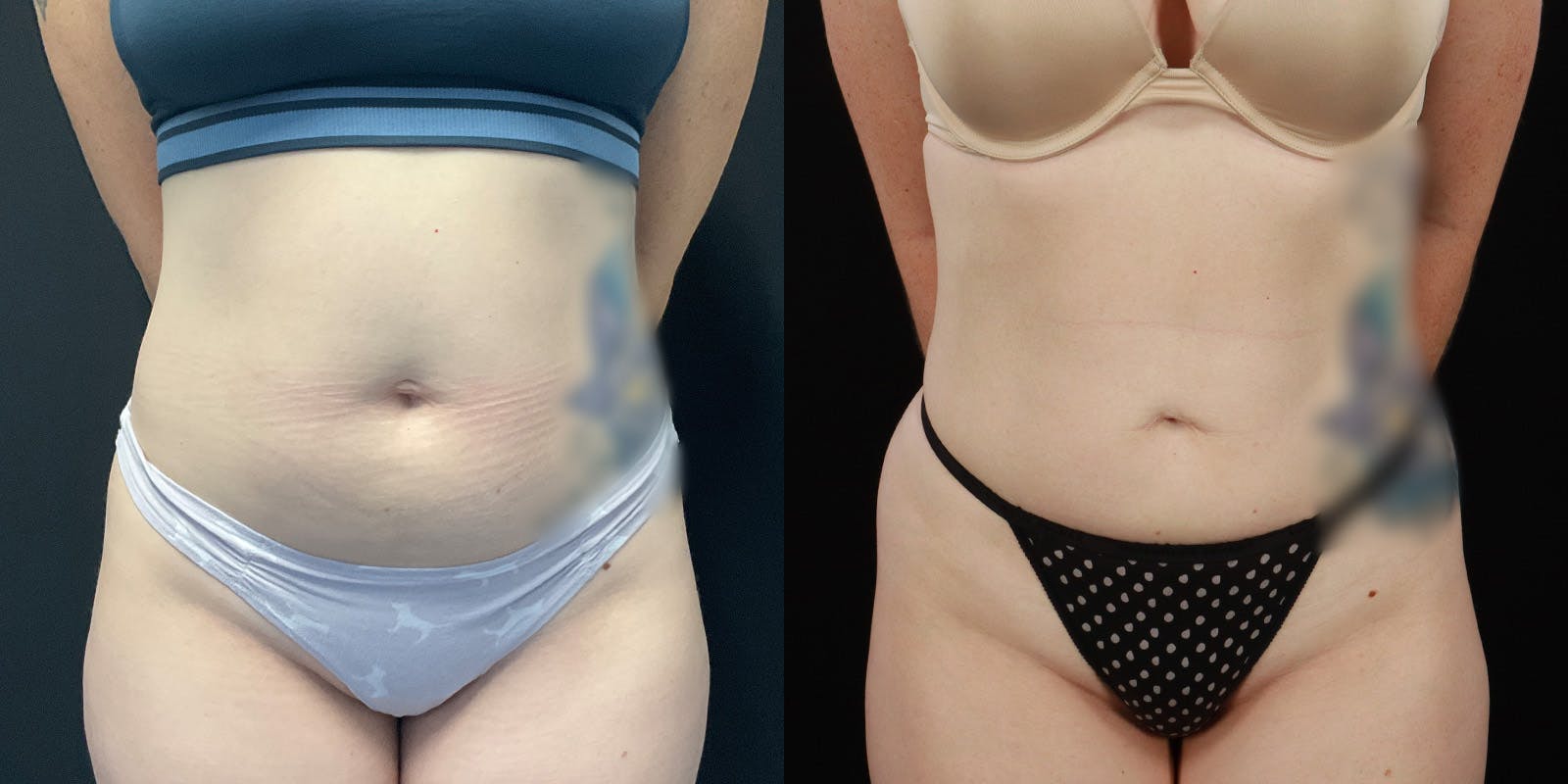 Bodytite By Inmode Before & After Gallery - Patient 388919 - Image 1