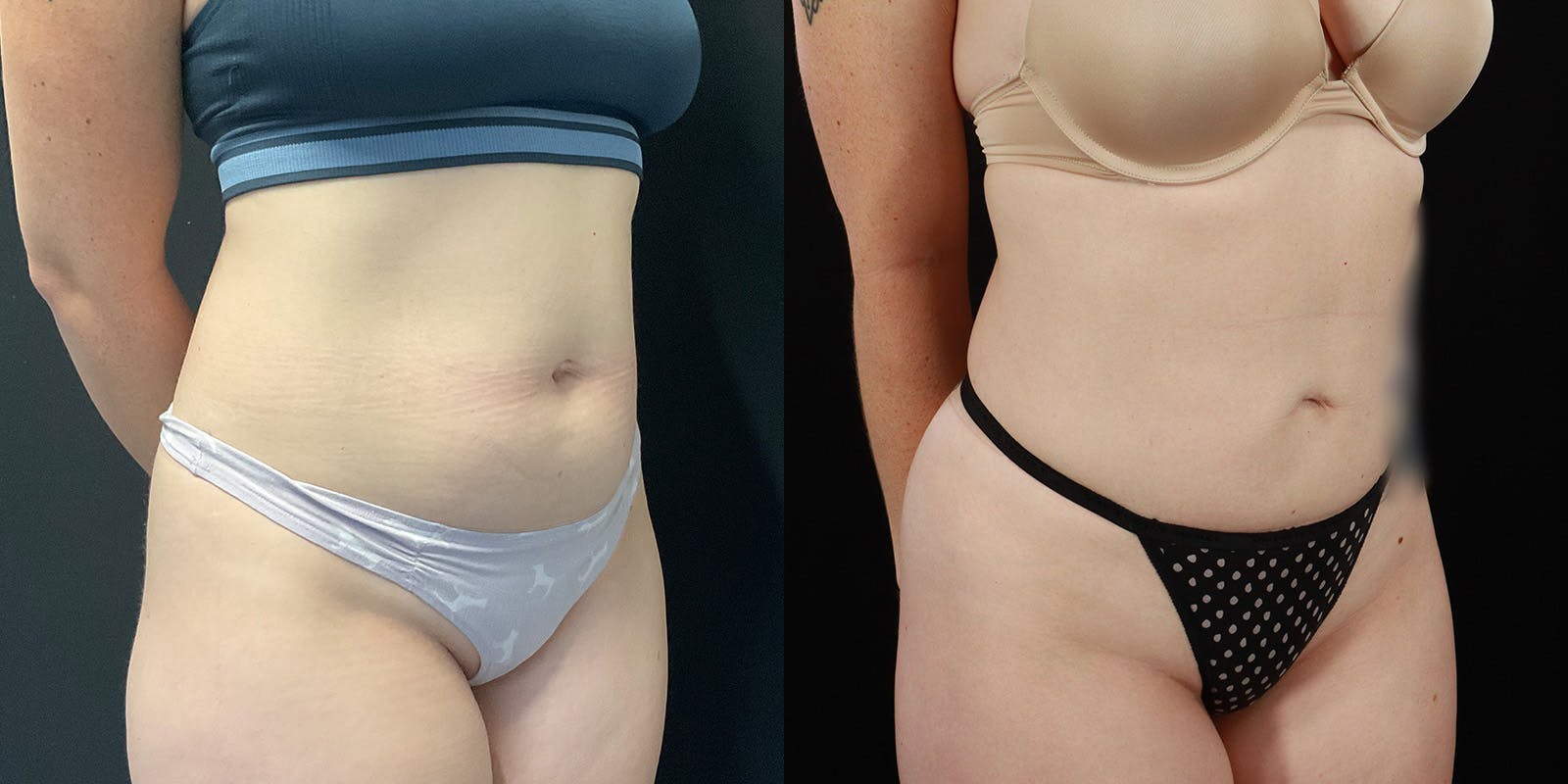 Bodytite By Inmode Before & After Gallery - Patient 388919 - Image 2
