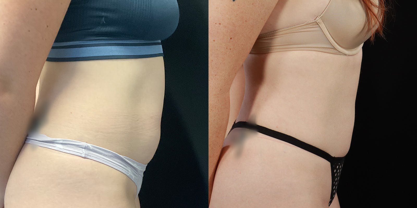 Bodytite By Inmode Before & After Gallery - Patient 388919 - Image 3