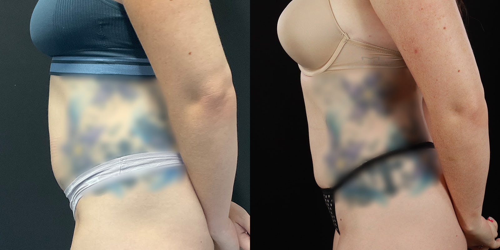 Bodytite By Inmode Before & After Gallery - Patient 388919 - Image 5