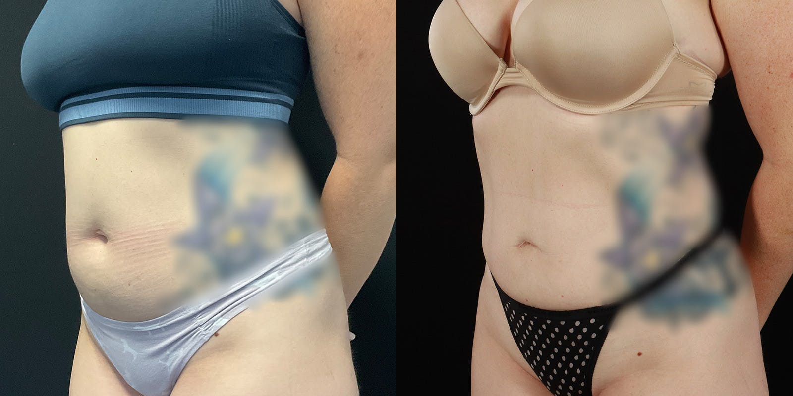 Bodytite By Inmode Before & After Gallery - Patient 388919 - Image 4