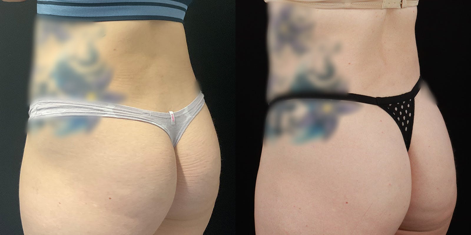 Bodytite By Inmode Before & After Gallery - Patient 388919 - Image 6