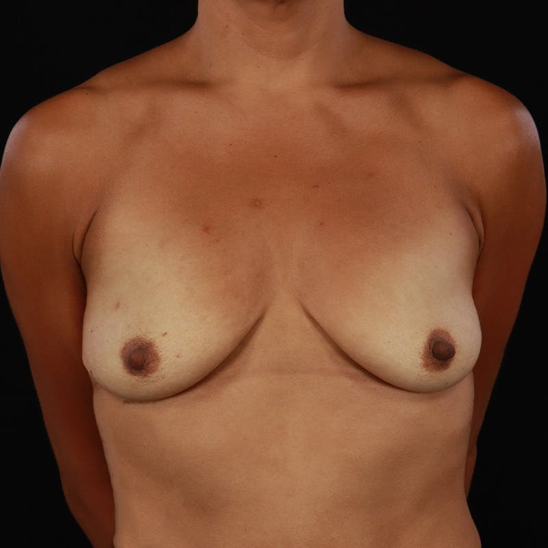 Breast Augmentation Before & After Gallery - Patient 942823 - Image 1