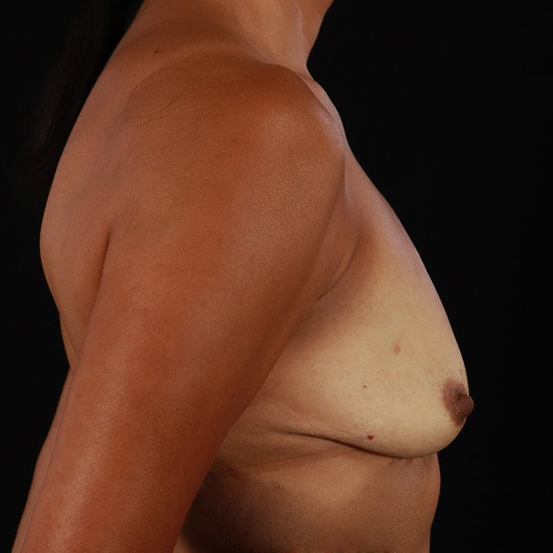 Breast Augmentation Before & After Gallery - Patient 942823 - Image 5