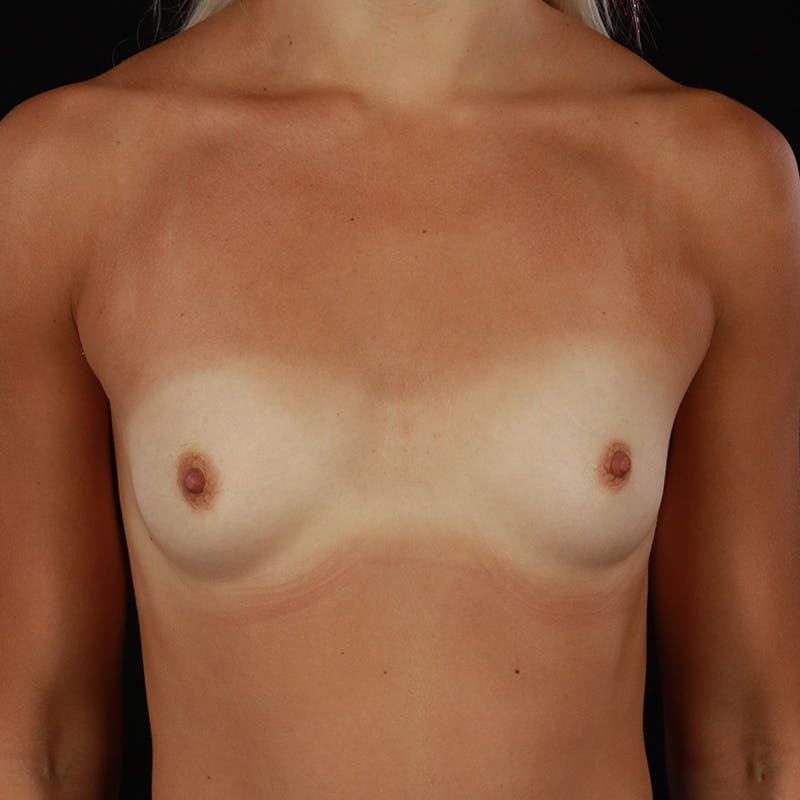 Breast Augmentation Before & After Gallery - Patient 492375 - Image 1