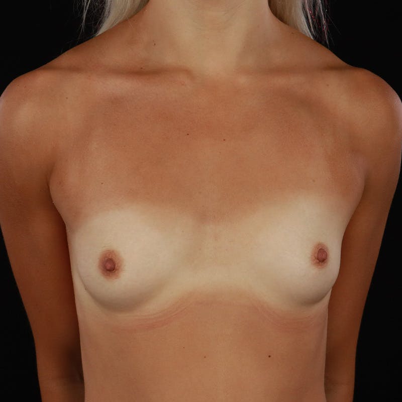 Breast Augmentation Before & After Gallery - Patient 492375 - Image 3
