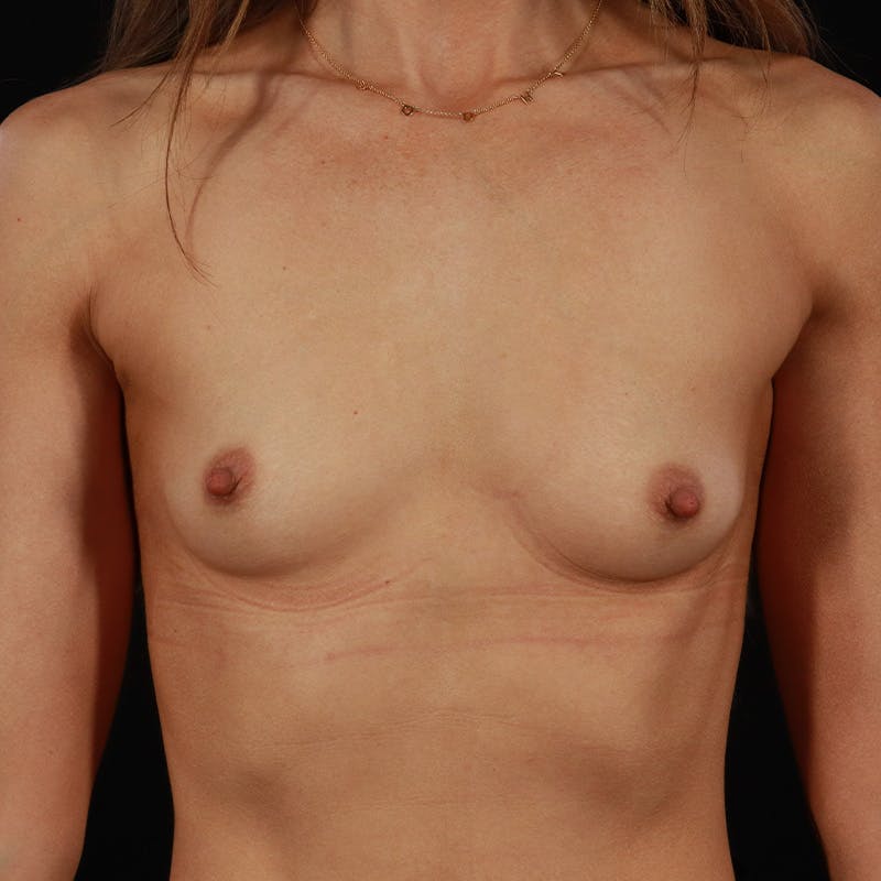 Breast Augmentation Before & After Gallery - Patient 249132 - Image 3