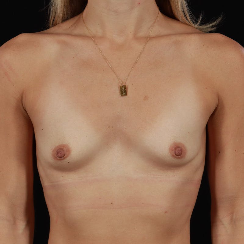 Breast Augmentation Before & After Gallery - Patient 408710 - Image 3