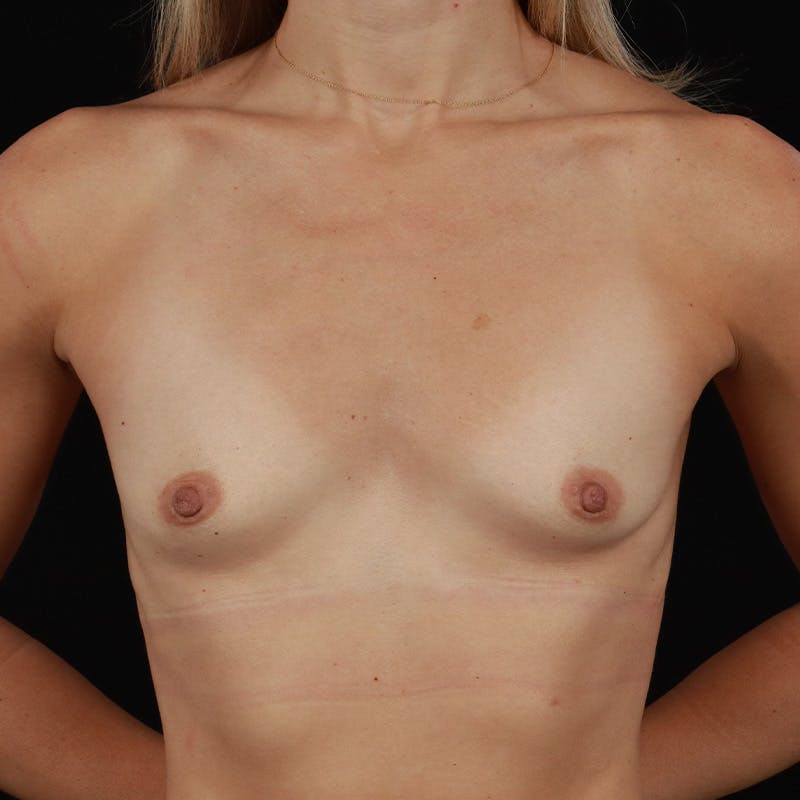 Breast Augmentation Before & After Gallery - Patient 408710 - Image 1