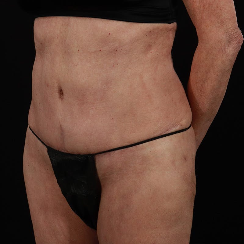 Abdominoplasty (Tummy Tuck) Before & After Gallery - Patient 397260 - Image 6