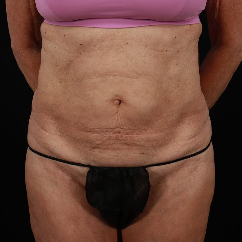 Abdominoplasty (Tummy Tuck) Before & After Gallery - Patient 397260 - Image 1