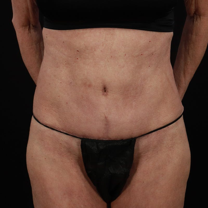 Abdominoplasty (Tummy Tuck) Before & After Gallery - Patient 397260 - Image 2