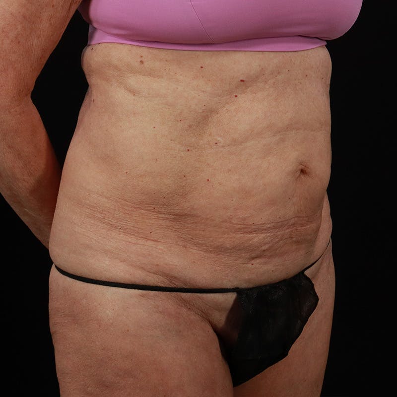 Abdominoplasty (Tummy Tuck) Before & After Gallery - Patient 397260 - Image 3